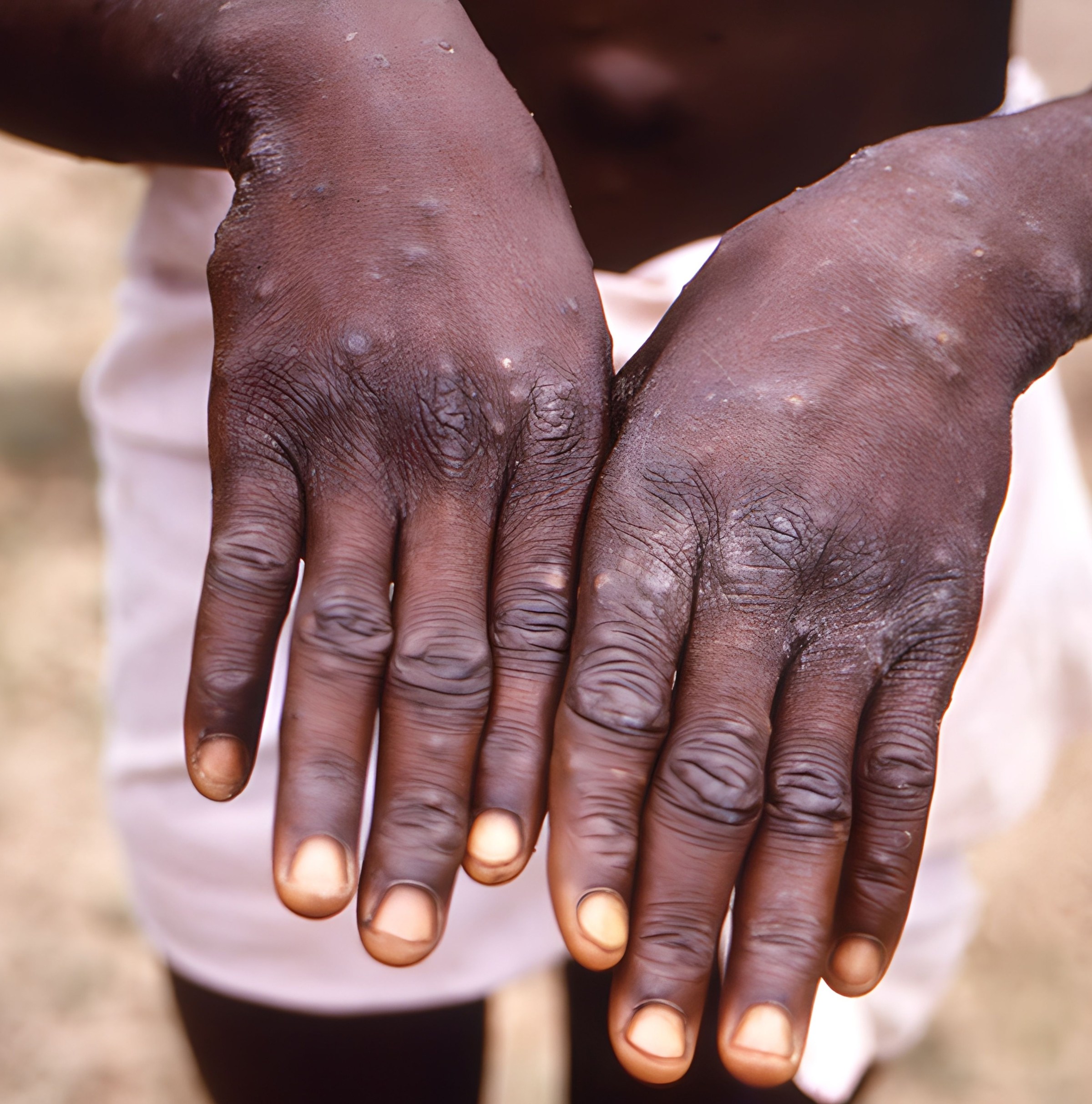 Mpox never stopped spreading in Africa. Now it’s an international public health emergency. Again.