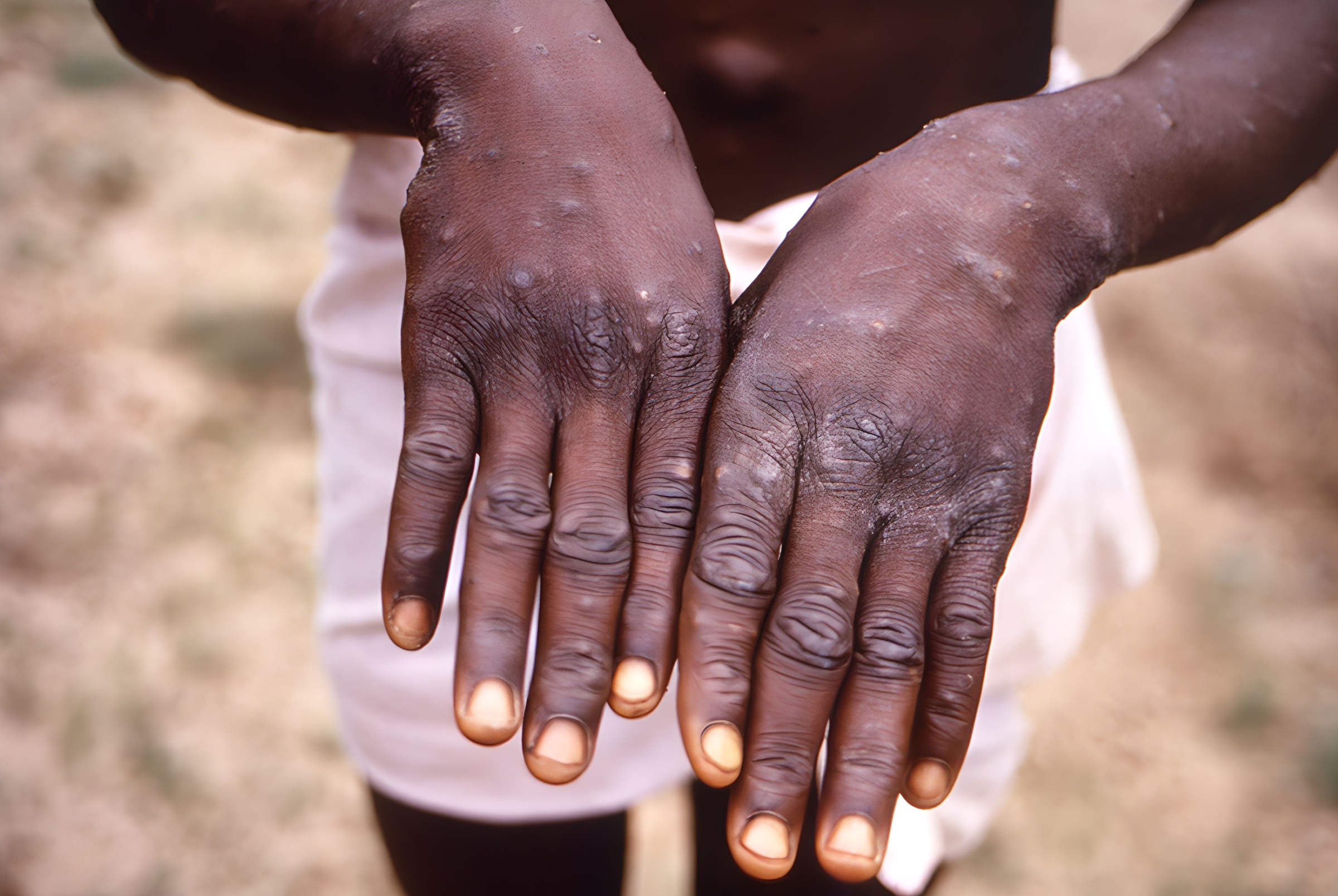 Mpox never stopped spreading in Africa. Now it’s an international public health emergency. Again.